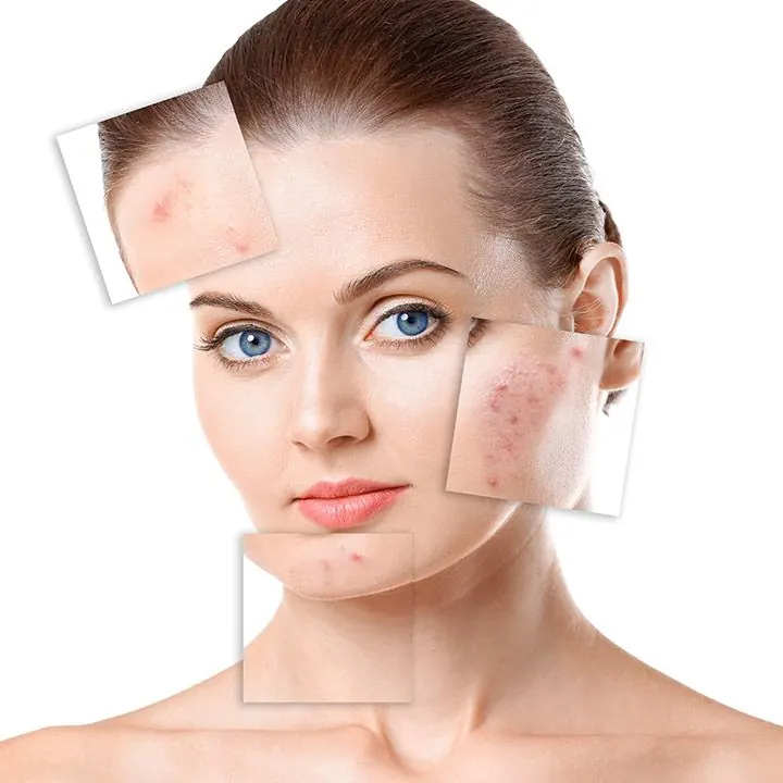 Acne Treatment treatment at Kira Exotica, a beauty salon in Indore
